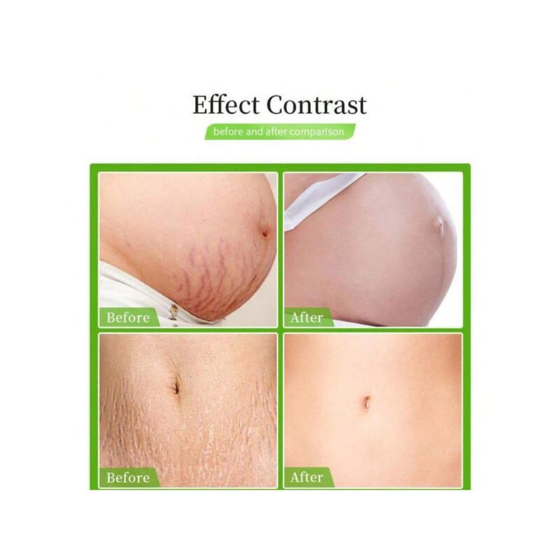 TRSTAY Stretch Marks & Scar Removal Cream set 3Pcs - Image 2